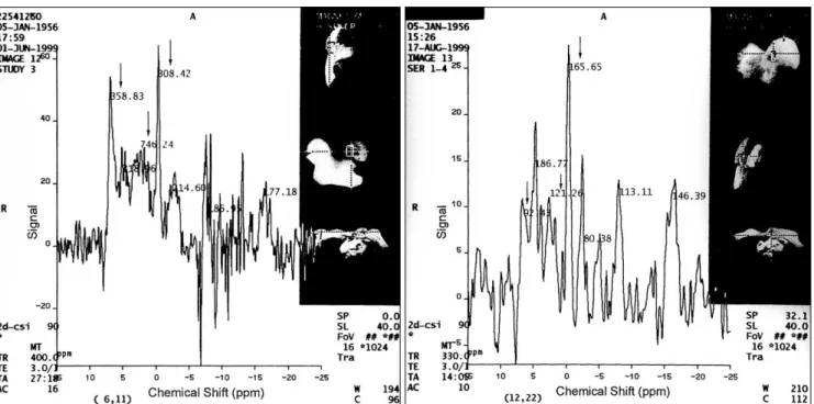 Fig. 3. 31P MRS of a 41-year-old normal volunteer. Note the highest peak of PCr (247.53)