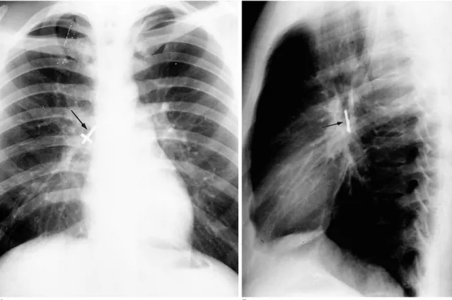 Fig. 2. Metallic cross in the bronchus intermedius of a 21-year-old man whose history remains unexplained.