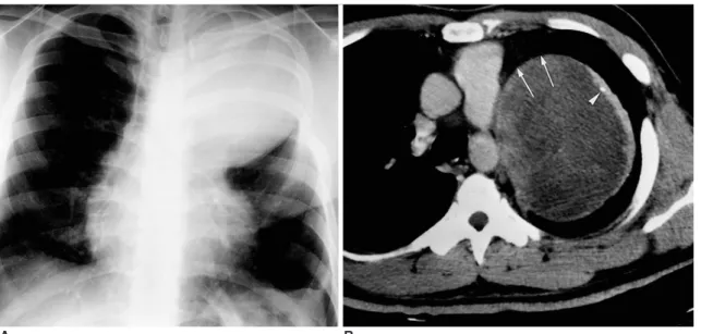 Fig. 8. A 35-year-old man who underwent pericardiectomy for pericarditis 20 years earlier
