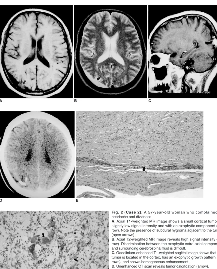 Fig. 2 (Case 2). A 57-year-old woman who complained of headache and dizziness. 
