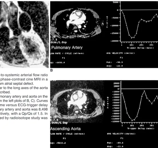 Fig. 2. Calculation of pulmonary-to-systemic arterial flow ratio (Qp/Qs) using velocity-encoded phase-contrast cine MRI in a 24-year-old female with a secundum atrial septal defect.