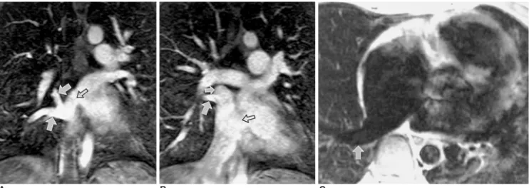 Fig. 3. 41-year-old female with partial anomalous pulmonary venous connection of right pulmonary veins to the right atrium and two atrial septal defects