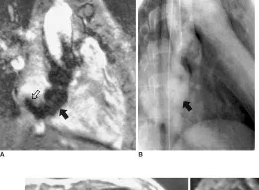 Fig. 11. Ebstein’s anomaly of the tricuspid valve in a 17-year-old female.