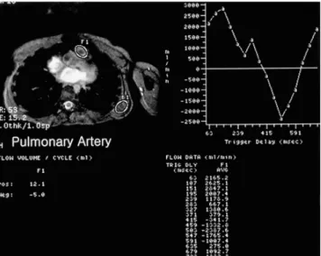 Fig. 14. Biventricular function evaluation using fast cine MR imaging and  semi-au-tomated ventricular function analysis software
