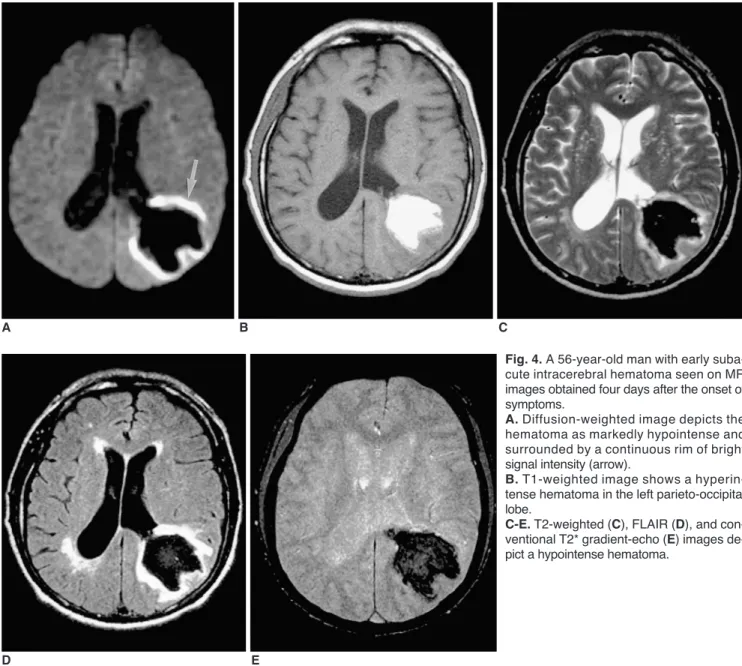 Fig. 4. A 56-year-old man with early suba- suba-cute intracerebral hematoma seen on MR images obtained four days after the onset of symptoms.