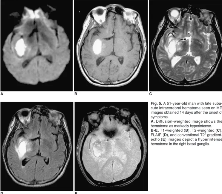 Fig. 5. A 51-year-old man with late suba- suba-cute intracerebral hematoma seen on MR images obtained 14 days after the onset of symptoms.