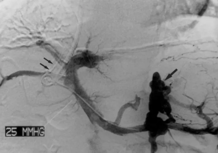Fig. 2. A 51-year-old man with alcoholic liver cirrhosis who under- under-went one standard TIPS and two parallel transcaval TIPS.