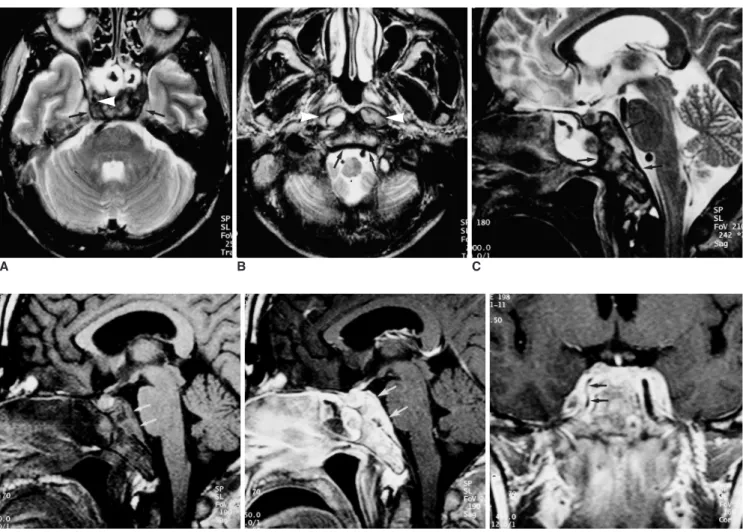 Fig. 1. A 42-year-old male patient who presented with a two-month history of headache and a four-day history of diplopia.