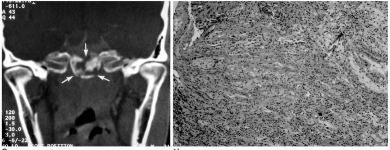 Fig. 1. A 42-year-old male patient who presented with a two-month history of headache and a four-day history of diplopia.