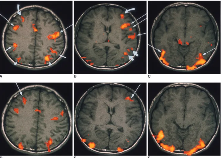 Fig. 1. Functional MR imaging of a healthy 26-year-old male obtained during verbal (A-C) and visual working memory tasks (D-F)
