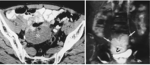 Fig. 5. Intestinal lymphoma developing intussusception in a 30-year-old woman.