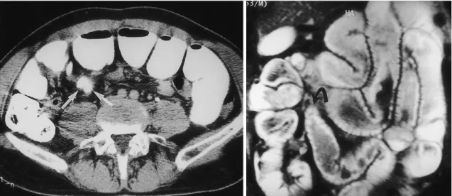 Fig. 6. Simple intestinal obstruction due to bowel adhesions in a 55-year-old man.