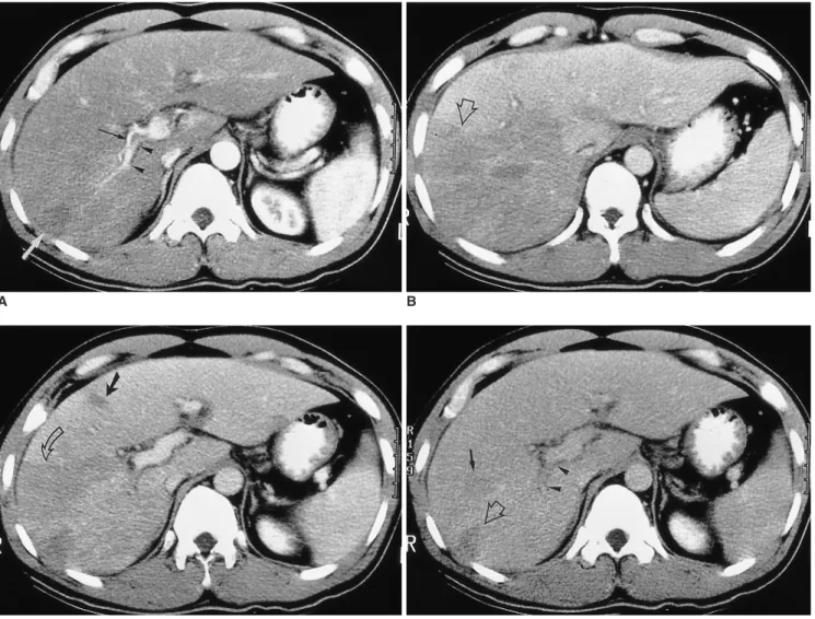 Fig. 1. A 37-year-old man (case 1) presented with right flank pain. Peripheral white blood cell count was 45,100/mm 3 , with 94% eosino- eosino-philia.