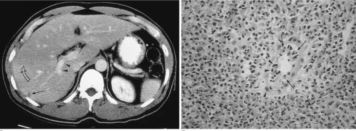 Fig. 1. E. Follow-up CT scan one month after corticosteroid treatment shows a subsegmental, faint zone of low-attenuation zone (open arrow) and a tiny subcapsular low attenuated lesion (arrow)