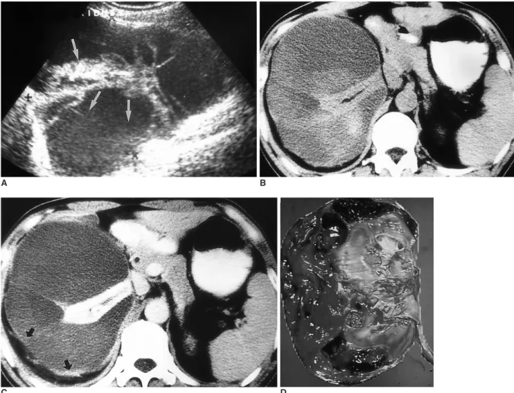 Fig. 2. A 38-year-old male with MCRCC in the right kidney (Case 5).