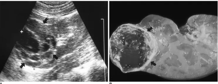 Fig. 3. A 43-year-old female with MCRCC in the right kidney (Case 6).