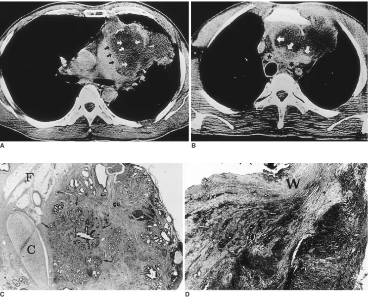 Fig. 1. A-49-year-old man and teratoma and malignant transformation.