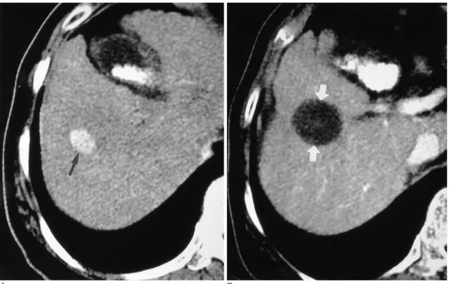Fig. 2. HCC located in the mid-zone of the liver surrounded by normal hepatic tissue in a 62-year-old man.