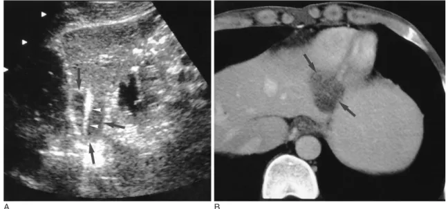 Fig. 3. HCC in a 45-year-old man. 