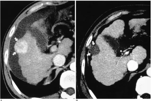 Fig. 4. HCC in a 57-year-old man. 
