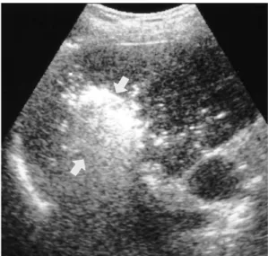 Fig. 5. Hepatic arterial-phase CT scan obtained 1 month after RF ablation of a 4-cm HCC surrounded by large branches of the  he-patic artery and portal vein shows a low attenuating ablated  le-sion (arrows) near the hepatic hilum