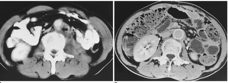 Fig. 2. A 41-year-old man with rupture of aortic aneurysm during surgery for drainage of psoas abscess