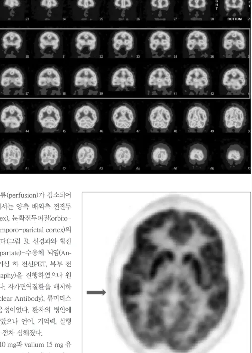 Fig. 2. SPECT image on hospital day  9. Mildly decreased perfusion of  right frontal &amp; temporal cortex.