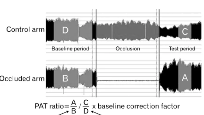 Fig.  2.  Measurement  of  microvascular  function.  PAT:  pe- pe-ripheral  arterial  tone.