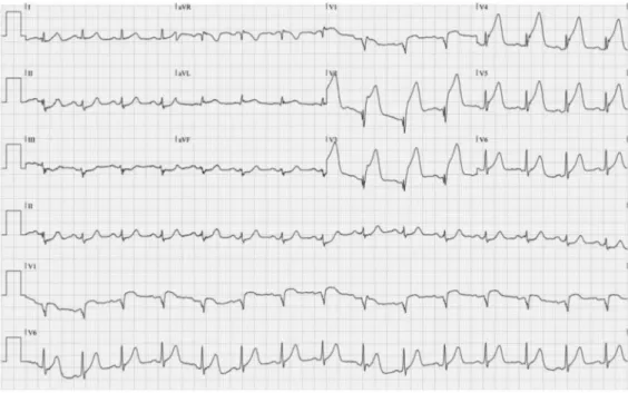 Fig. 1.  Initial electrocardiogram shows extensive ST segment elevation on precordial leads