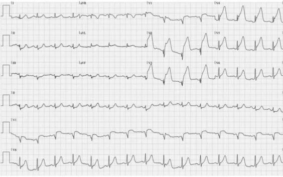 Fig. 1.  Initial electrocardiogram shows extensive ST segment elevation on precordial leads