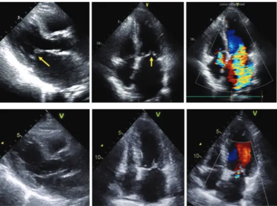 Fig. 3.  Transthoracic echocardiograms show dynamic change of mitral regurgitation. Mitral leaflets do not coap- coap-tation on end-systole (arrows at parasternal long axis view and apical four chamber view images on upper panel) and color Doppler image sh