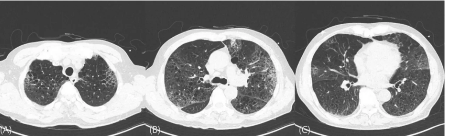 Fig. 3. Chest computed tomography scan revealed multifocal ground-glass opacities with consolidation in both upper lung fields (A), the right middle lung (B), and the lingular segment of the left upper lung with  pe-ripheral preponderance (C)