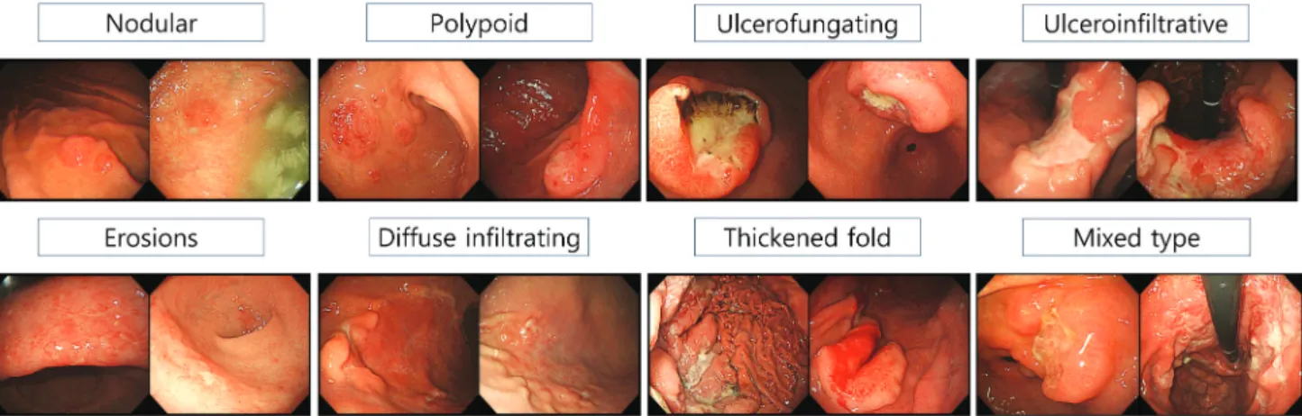Fig. 2. Endoscopic classification for gastric lymphomas 