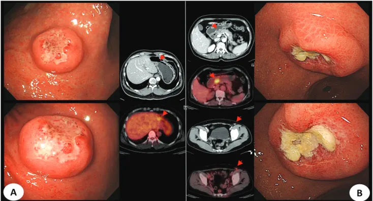 Fig. 3. PET-CT features of endoscopically polypoid mass-like lesions in primary DLBCL (A) and secondary DLBCL (B) cases (Abbreviation