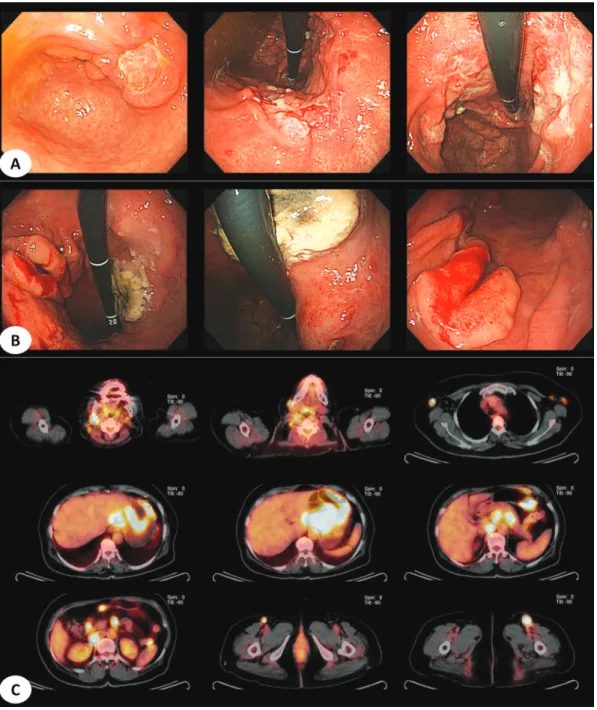 Fig. 5.  Two cases of mixed type with two or more endoscopic findings. (A) Primary DLBLC