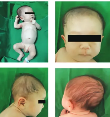 Fig. 1. General appearance of the patient shows an asymmetric head(Plagiocephaly), low-set ears, small