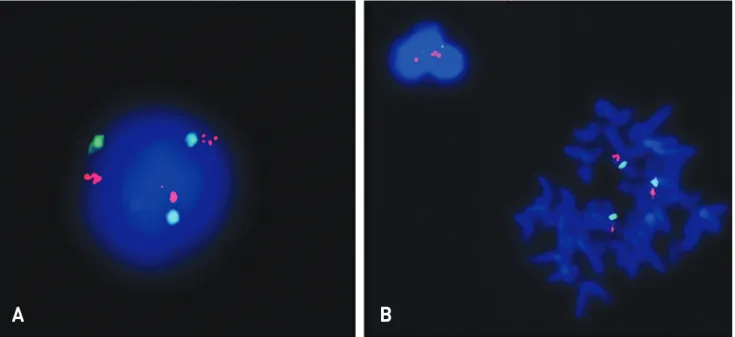 Fig. 3. Results of analysis of lymphocytes in peripheral blood with 9p (red) and 9p (green) FISH probes (Cytocell Ltd, UK) : Three signals are shown in 11% of interphase (A) and metaphase (B) cells, consistent with the diagnosis of mosaic trisomy 9
