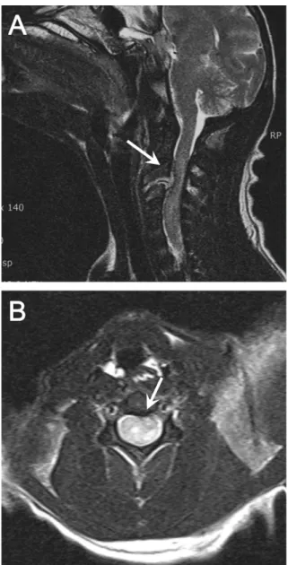 Figure 2. (A) Sagittal T2-weighted image of a suspected extradural compressive material above C2-C3
