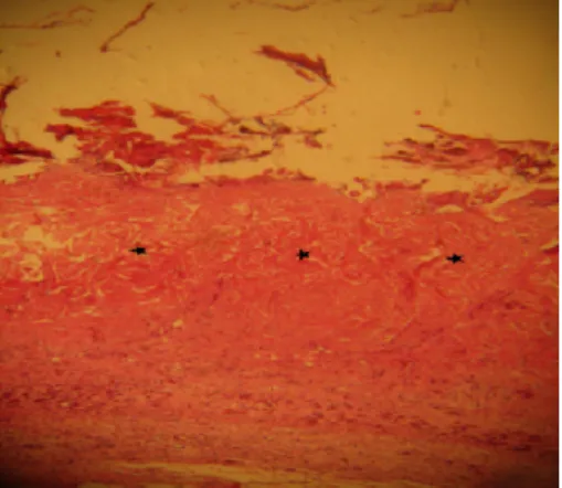 Figure 2. Histological view of an experimental pressure sore caused by maximum pressure generated with no