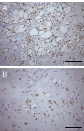 Figure 3. Photographs of the tumor with immunohistochemical stains. (A)  Immunohistochemistry for vimentin shows diffuse positive reactions