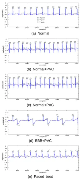 Fig. 4 Total peak detection result of arrhythmia type