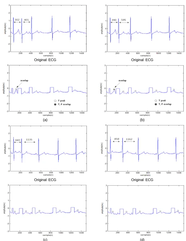 Fig. 6 Detected T wave of moving average (4 PAC pattern) (a) 105 (Normal+PAC) Pattern A overlap (b) 119  (Normal+PAC) Pattern B overlap (c) 209 (Normal+PAC) Pattern C non overlap (d) 233 (Normal+PAC) Pattern D  non overlap