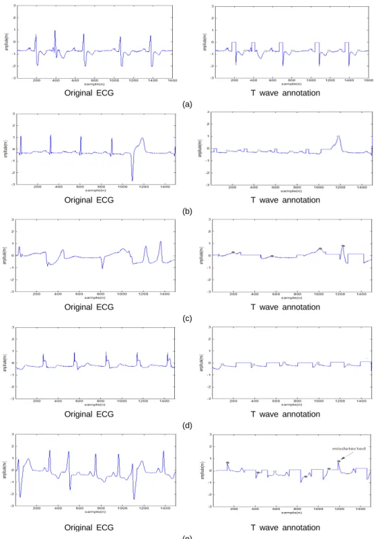 Fig. 7 Detected T wave of another arrhythmia (a) 100, 101, 102, 106 record (Normal) (b) 100, 102, 107, 233  record (Normal+PVC) (c) 205, 207(Normal+Paced+LBBB+PVC) overlap (d) 102, 107, 217 (Paced beat) (e) 233  record (PVC+PVC+Normal+PVC)