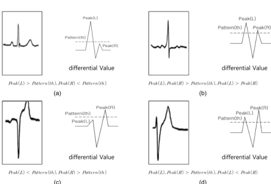 Fig. 2 QRS pattern (a) Normal (b) Pattern A(PVC) (c) Pattern B(PVC) (d) Pattern C(PVC)