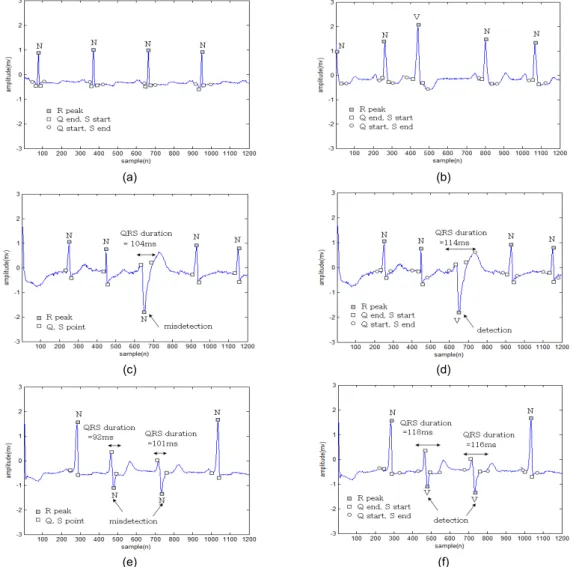 Fig. 6 QRS feature detection performance (a) record 100 (Normal + Pattern B) (b) record 105 (Normal + Pattern A)  (c) record 213 (Normal + Pattern C): traditional method (d) record 213 (Normal + Pattern C): proposed method (e)  record 233(Normal + Pattern 