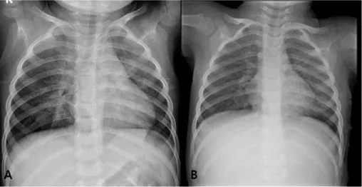 Fig. 1. (A) Chest X-ray done at the first day in our hospital shows mild haziness in the right lung and suspicious haziness in the lower lobe of left lung