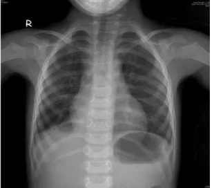 Fig. 2. Axial chest computed tomphy reveals unu- unu-sual approximation between the right bronchus (white arrow) of pathologic area and the dilated air-contained esophagus (black arrow).