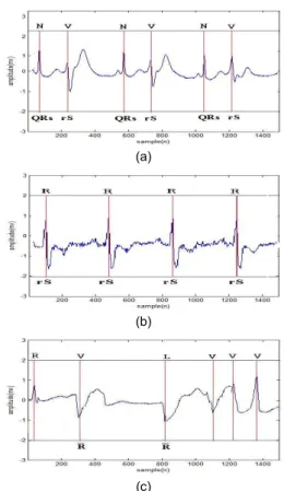 Fig. 7 Detection of duplicated pattern (a) PVC(106 record)  (b) RBBB(118 record) (c) PVC &amp; LBBB(207 record)