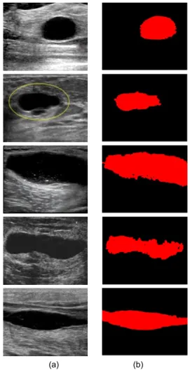 Fig. 4 Ganglion cysts candidate extraction by 8-directional  contour tracking (a) Enhanced fuzzy binarization (b) 8-  directional contour tracking