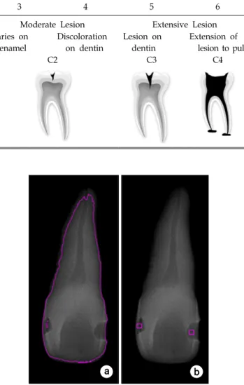 Table 1. Tooth status corresponding to ICDAS and four stages of tooth decay.